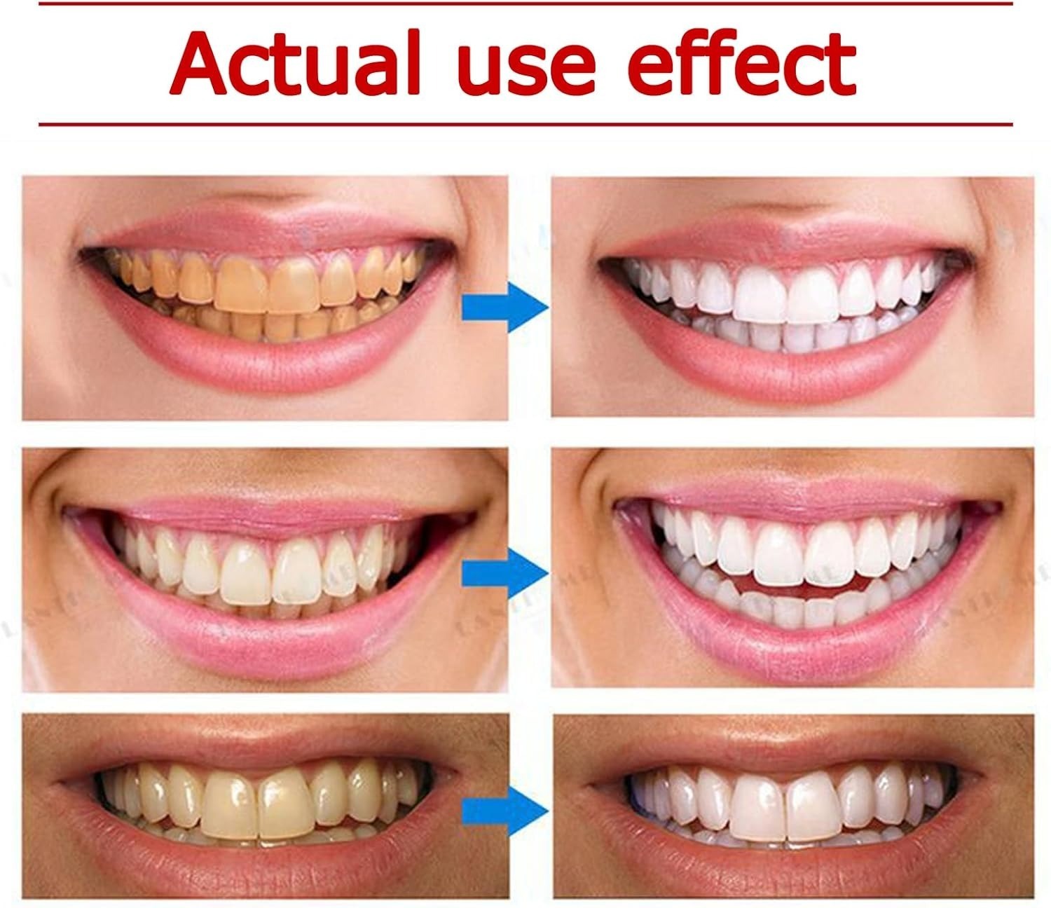 Yayashi SP-4 Ultra Whitening Toothpaste ? 150ml Probiotic Stain Remover for Bright, Healthy Teeth - Image 5
