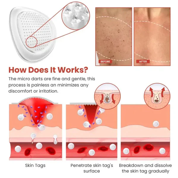 DermaSmooth Skin Tag Remover Patch ? Fast, Safe, And Painless Skin Tag And Mole Removal Solution With No Scarring Or Pigmentation - Image 3