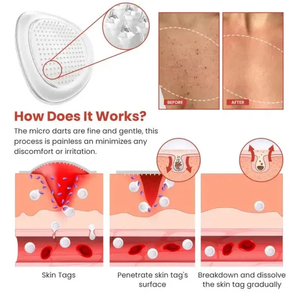 DermaSmooth Skin Tag Remover Patch ? Fast, Safe, And Painless Skin Tag And Mole Removal Solution With No Scarring Or Pigmentation - Image 2