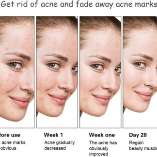 Aichun Beauty Anti - Acne Whitening Facial Serum Aloe Vera Extract Salicylic Acid Repairs Damaged Skin | 30ml