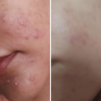 Nirvana Botanics Vitamin C + E Serum - 15ml | ANTI ACNE & GLOWING SERUM VITAMIN C + E