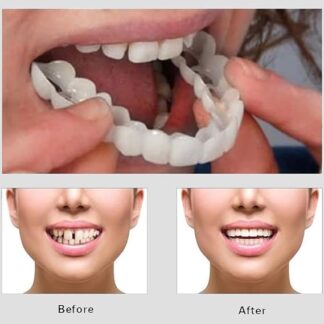 Snap On Smile - Veneers Teeth for Men and Women - Moldable False Artificial Braces Teeth