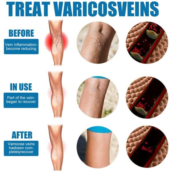 2d4add2a5f961ce4920eb207a174b0ef South Moon Varicose Veins Treatment Spray – 30ml Advanced Formula for Spider Veins, Leg Pain & Swelling Relief | Natural Herbal Spray for Better Circulation