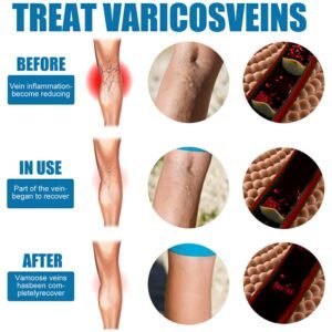 9b30b2a7e5342217e60514f0578bd5e8 Varicose Veins Treatment Spray – Advanced Formula for Spider Veins, Leg Pain & Swelling Relief ~ 30ml